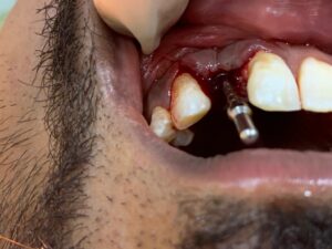 Dental Implants