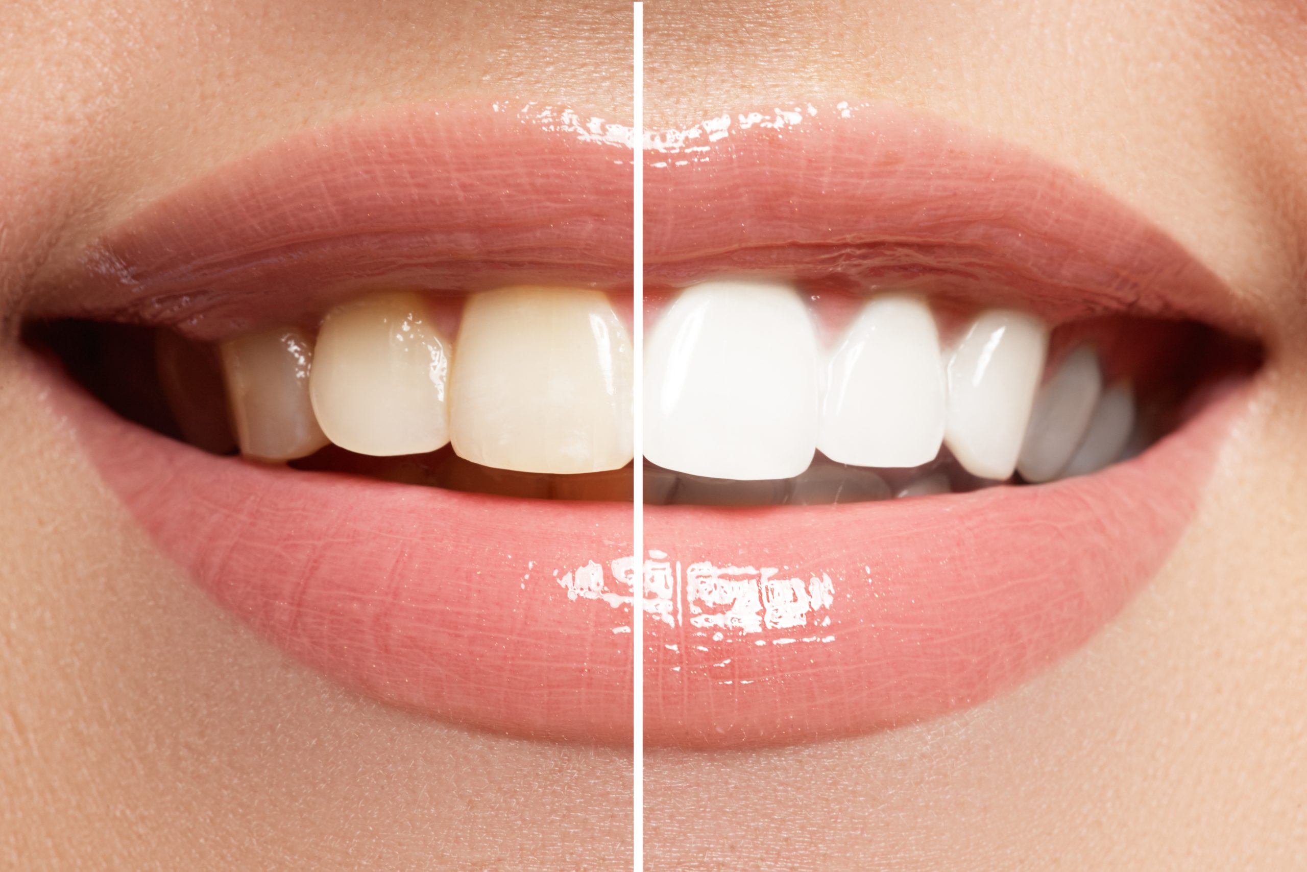 teeth whitening park dental