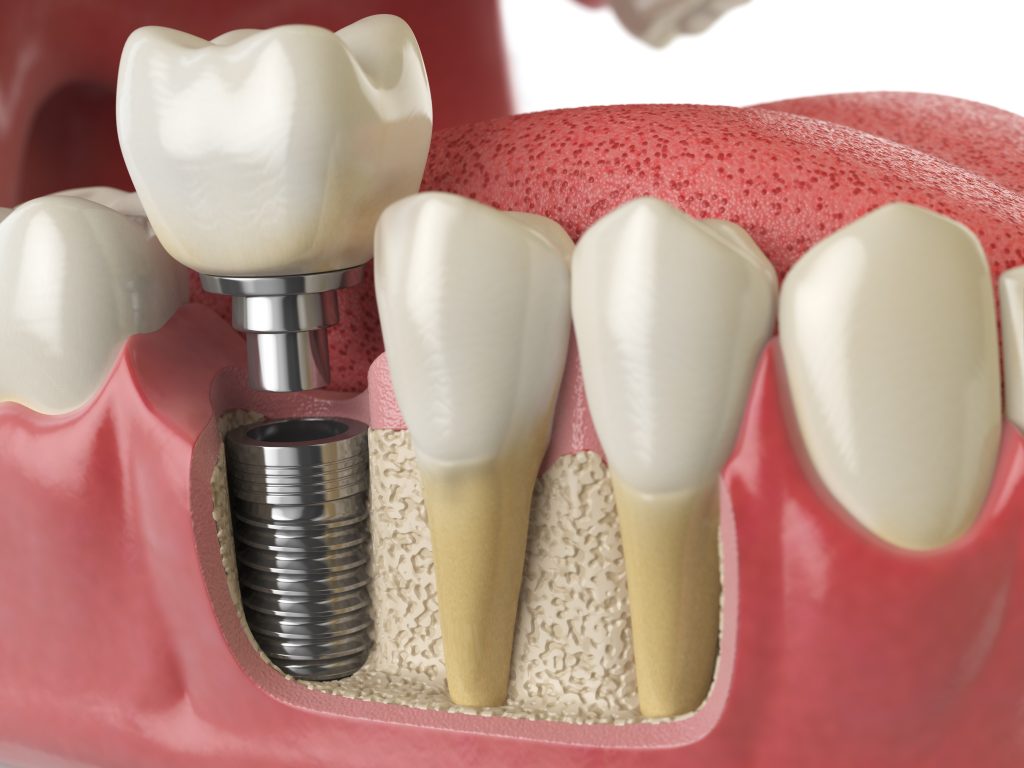 best dental implant clinic