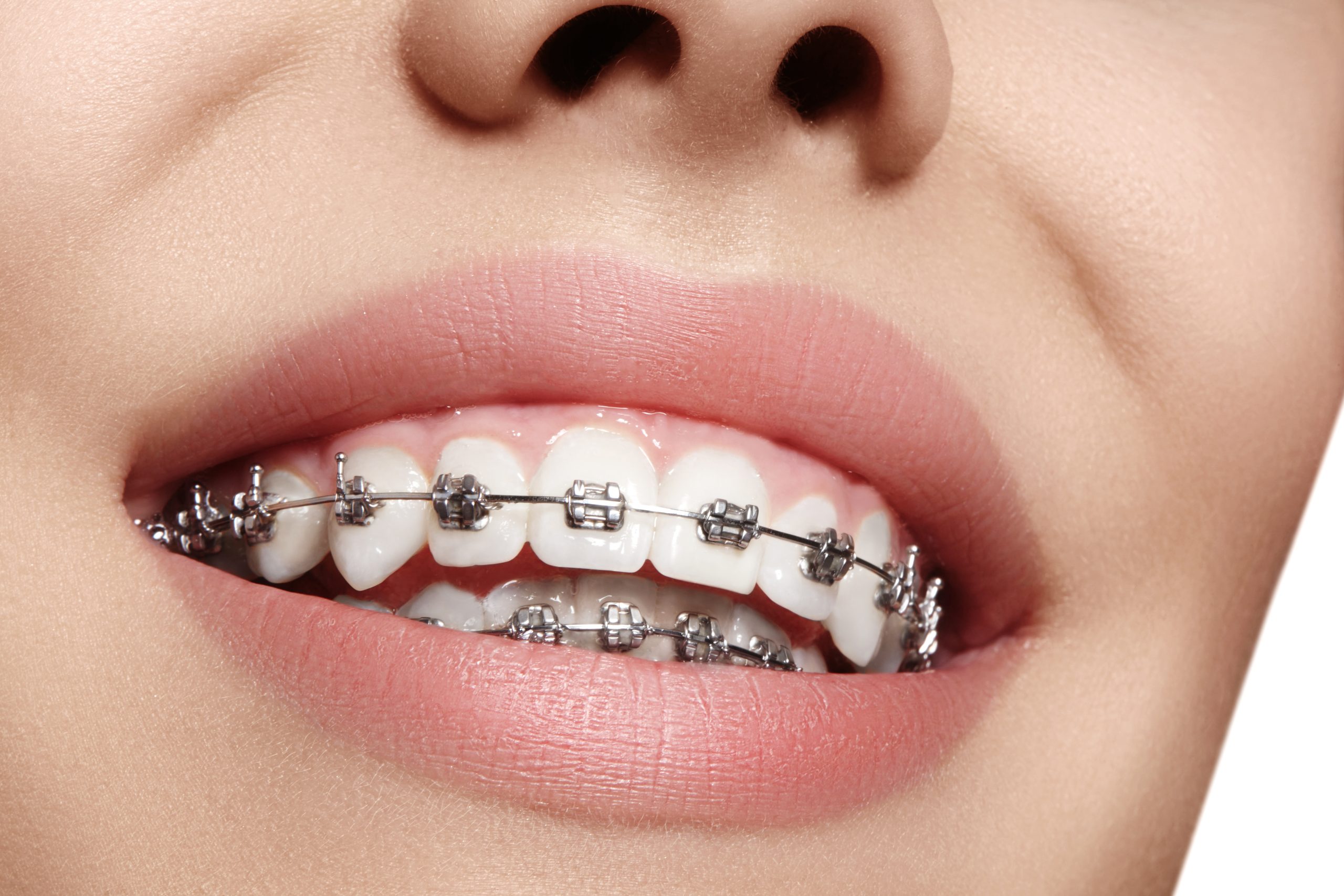 How Do Braces Work to Straighten Your Teeth & Types of Braces?