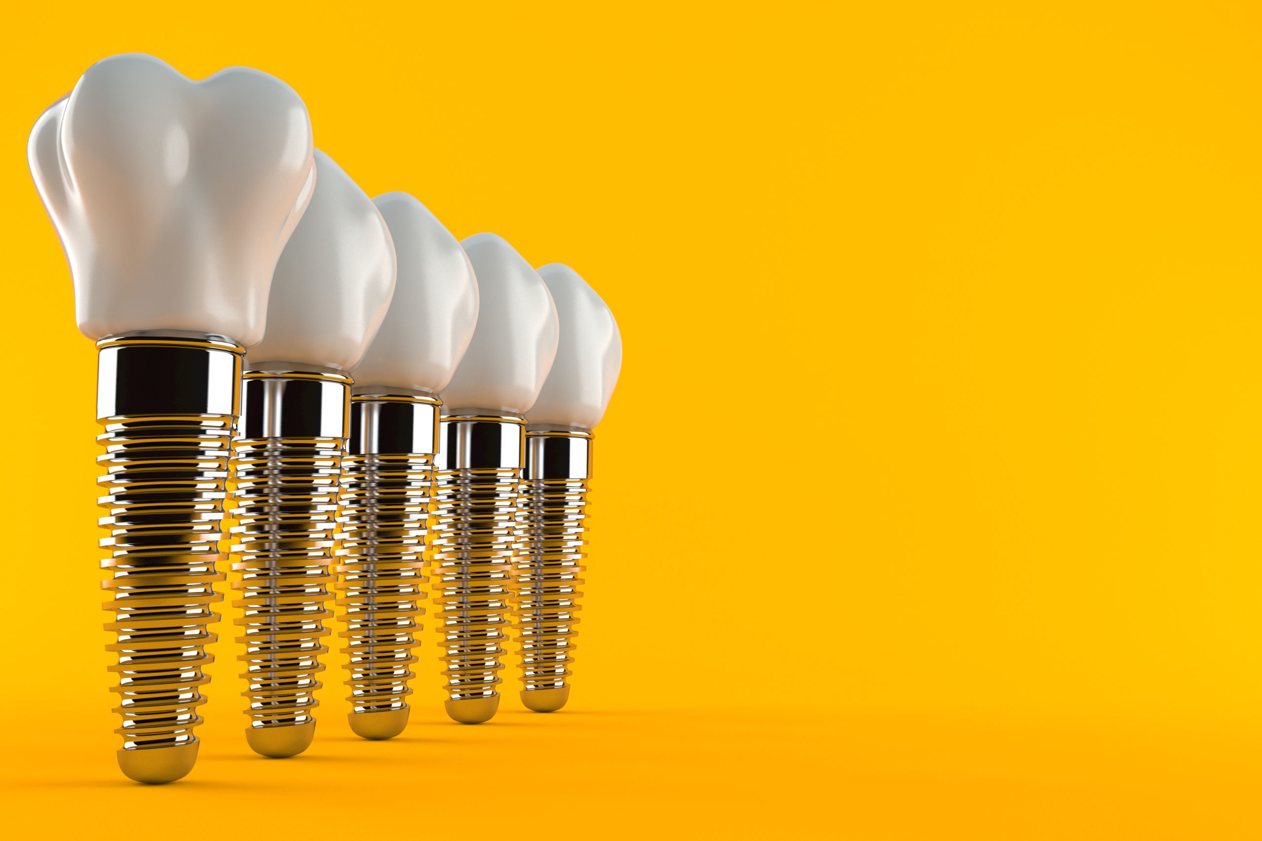 Dental Implants: Everything You Need to Know