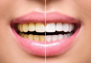 THE SCIENCE BEHIND TEETH WHITENING AND HOW IT WORKS