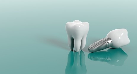 When is Dental Implant Surgery Is Required ?