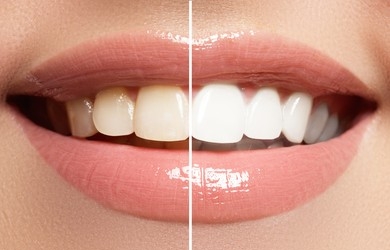 Six Ways To Get Perfect White Teeth Like Celebrities