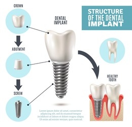 Full Mouth Implants Before and After