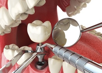 tooth Implant