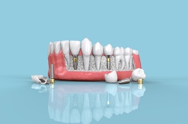 Latest Advancement In Dental Implants And Braces