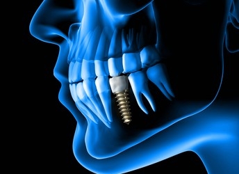 Dental Implant x-ray