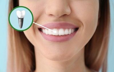 Different Types And Benefits Of Dental Implants- Explanation