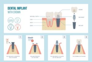 Dental Implant crown