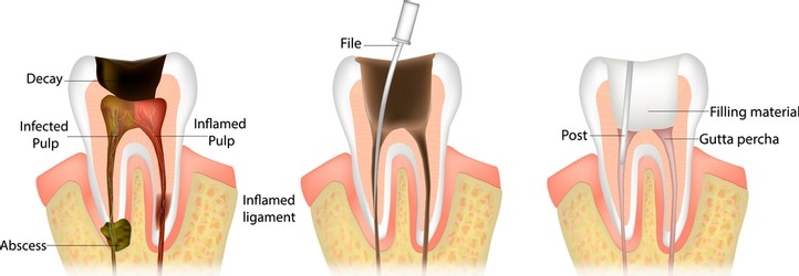 Best Oral Health Decisions: Root Canal Vs Tooth Extraction