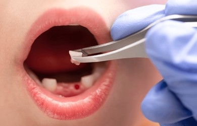 Milk Tooth, Pediatric Tooth Extraction