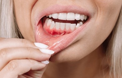 Dental gums gum inflammation