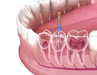 Root Canal