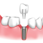 Dental Implant Park dental