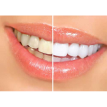 Teeth Whitening Park dental
